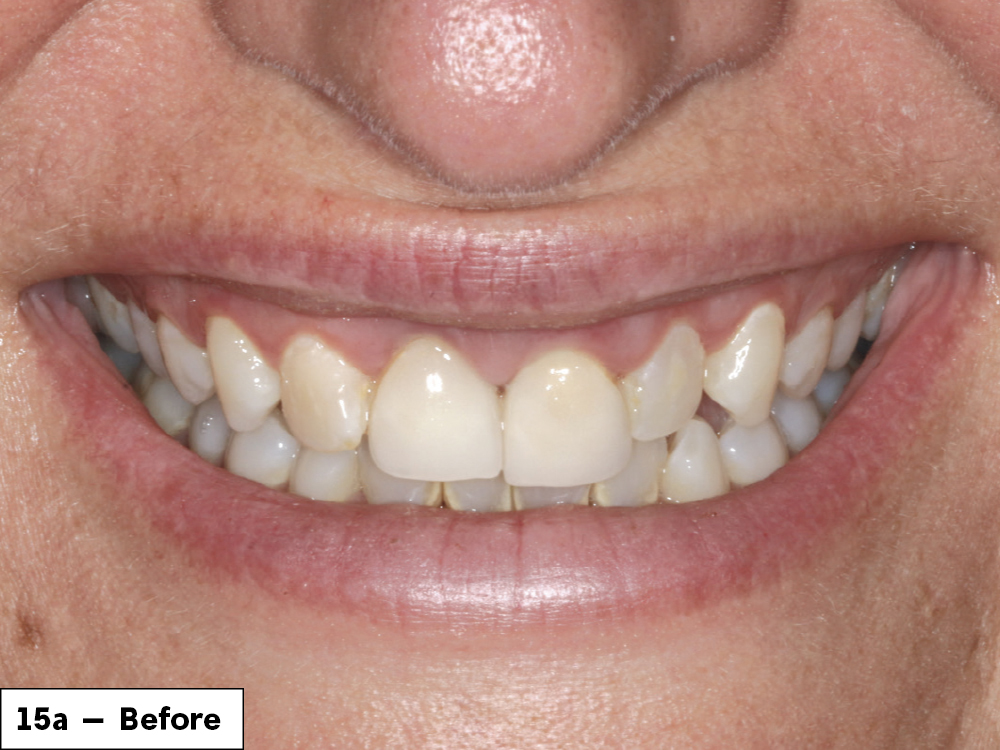 Figure 15a: Before patient photo