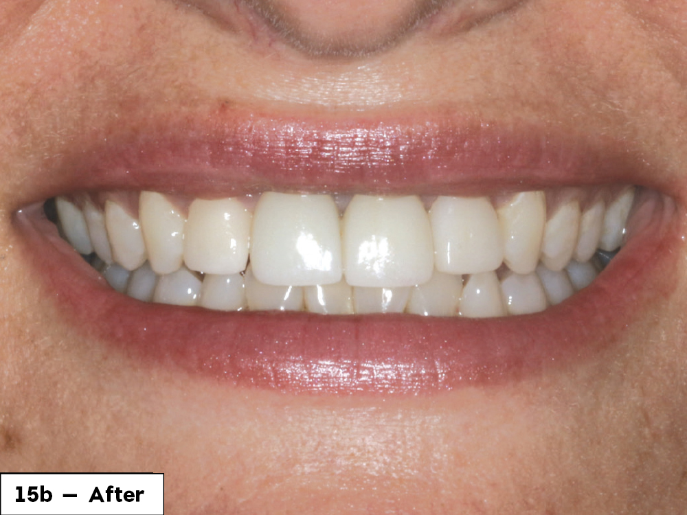 Figure 15b: After patient photo