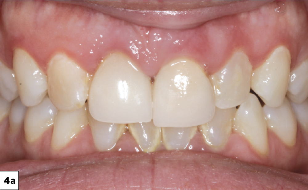 Figure 4a: patient's teeth before extraction