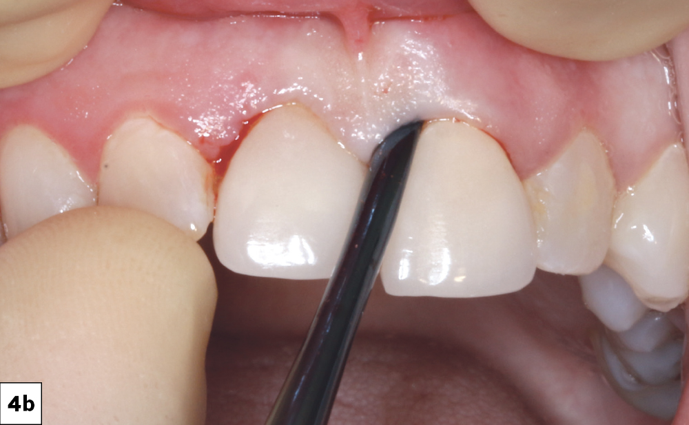 Figure 4b: periotome to release soft tissue