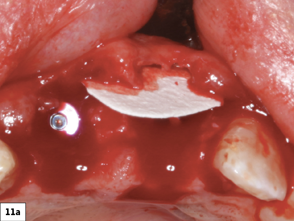 Figure 11a: A Newport Biologics™ Resorbable Collagen Membrane used