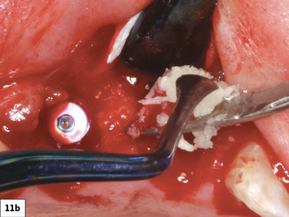 Figure 11b:  Newport Biologics Mineralized Cortico/Cancellous Allograft Blend was placed afterwards