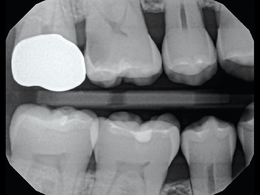Figure 1: X-ray revealed extensive caries on the distal of #3