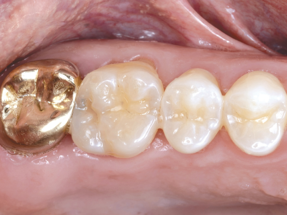 Figure 2: large carious lesion was visible intraorally