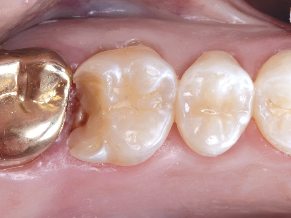 Figure 5: 3M™ Vitrebond™ Light Cure Glass Ionomer Liner is placed for protection