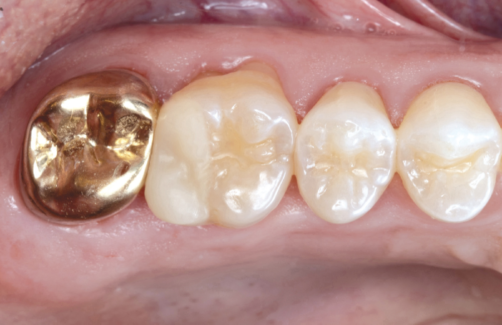 Figure 10: before cementation