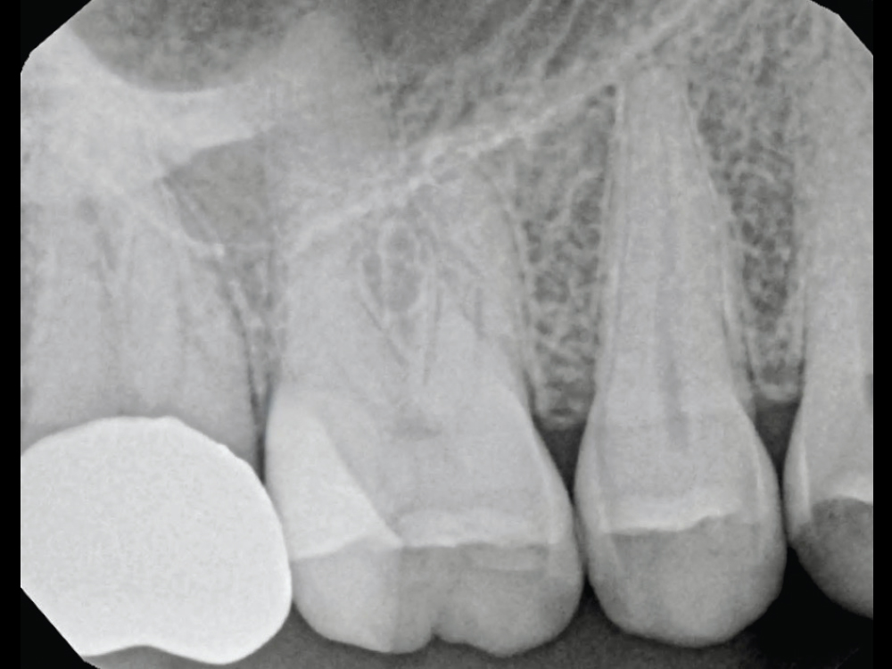 Figure 12: The post-treatment radiograph