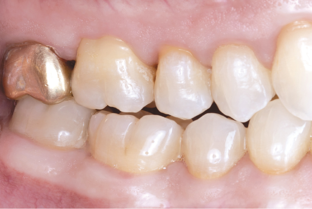 Figure 11: 3M RelyX™ Ultimate Adhesive Resin Cement used