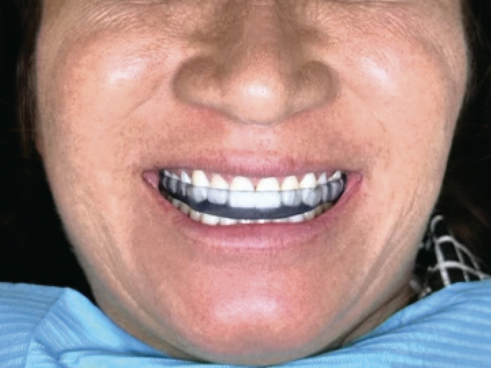 End result with 3D-printed occlusal guards installed 