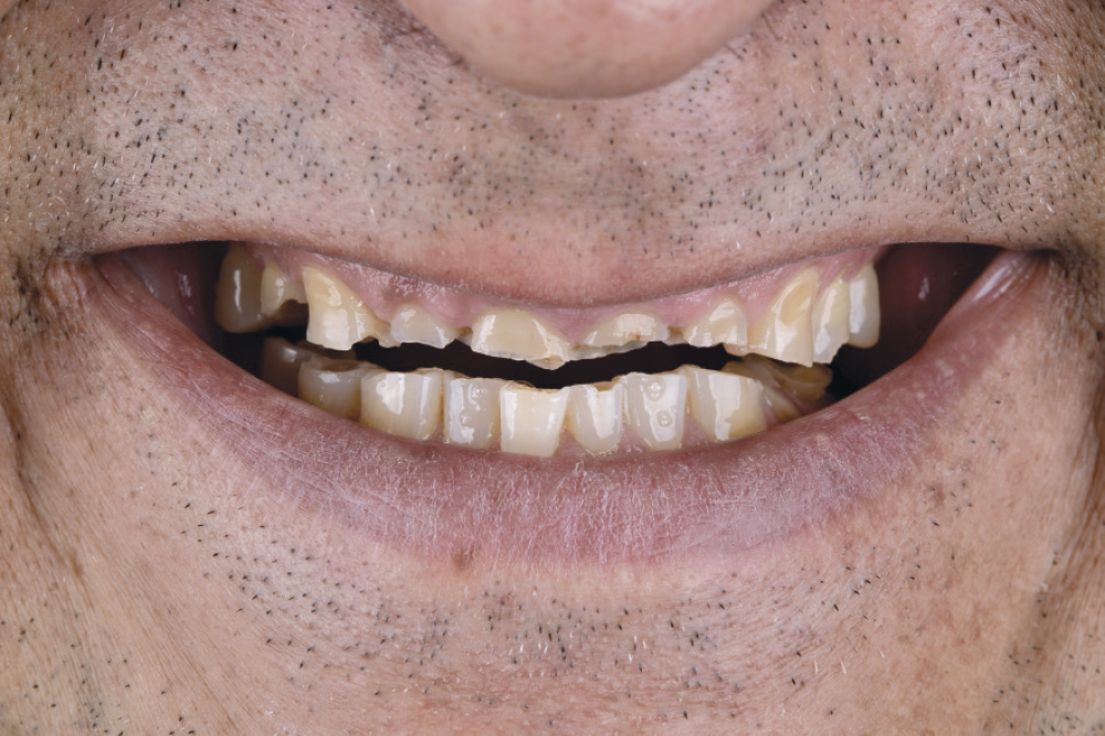 Before digital dentistry and BruxZir® restorations