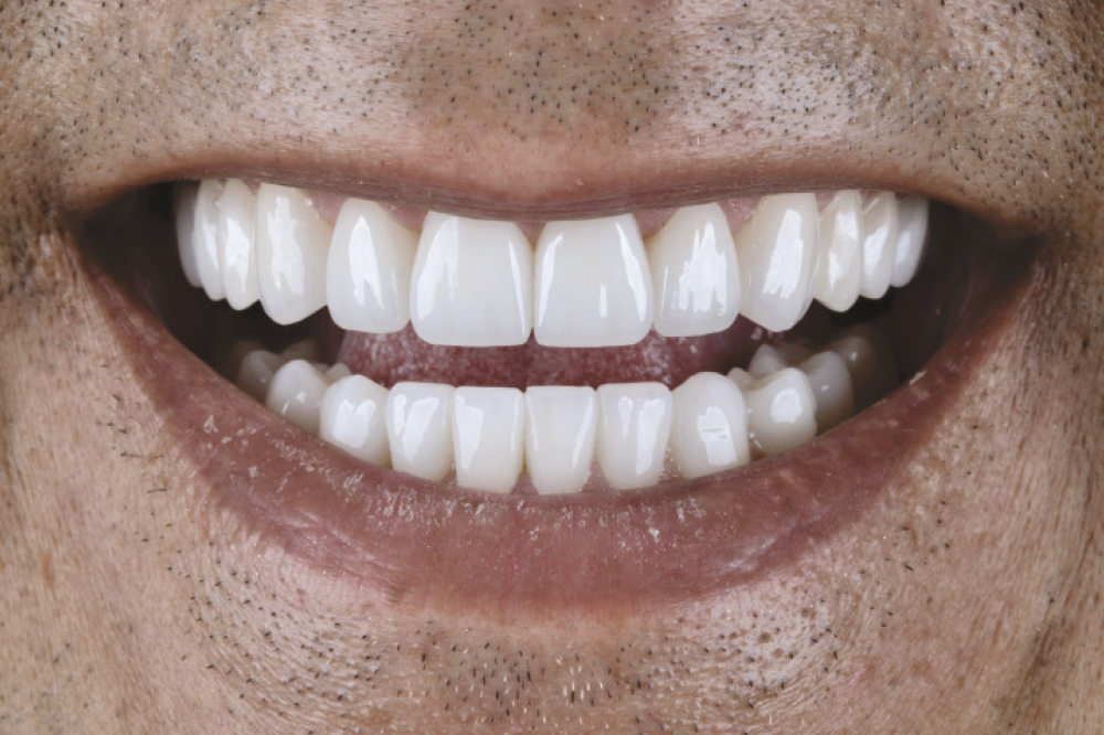 After digital dentistry and BruxZir® restorations