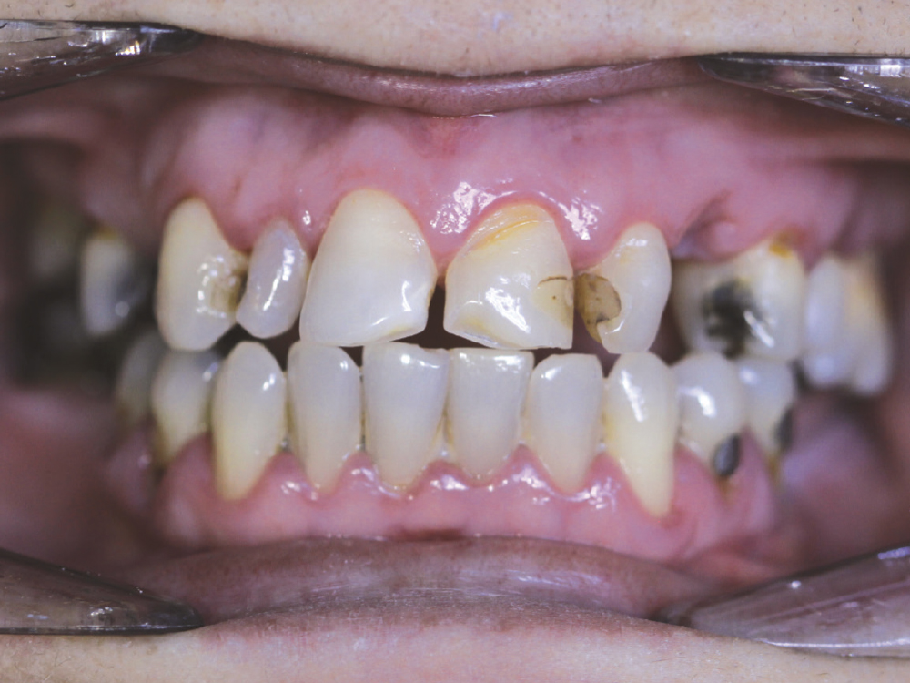 Dr. Waich provided a patient requiring multiple restorations with BioTemps® NOW crowns that were both comfortable and esthetically pleasing, and mirrored the look and feel of the permanent restorations.