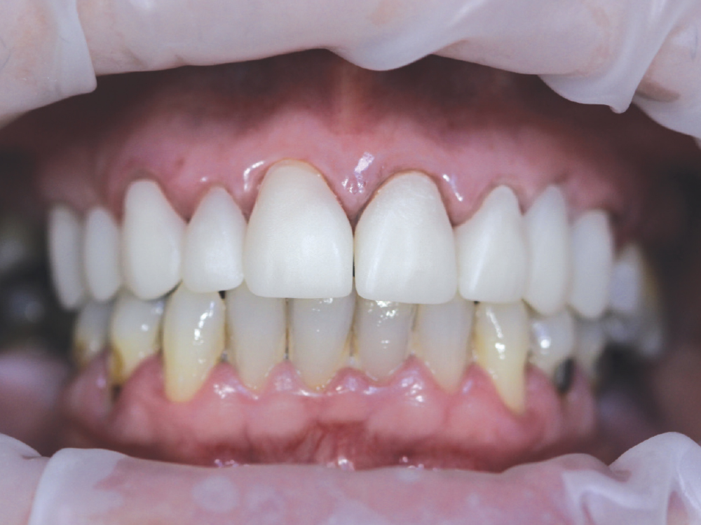 Dr. Waich provided a patient requiring multiple restorations with BioTemps® NOW crowns that were both comfortable and esthetically pleasing, and mirrored the look and feel of the permanent restorations.