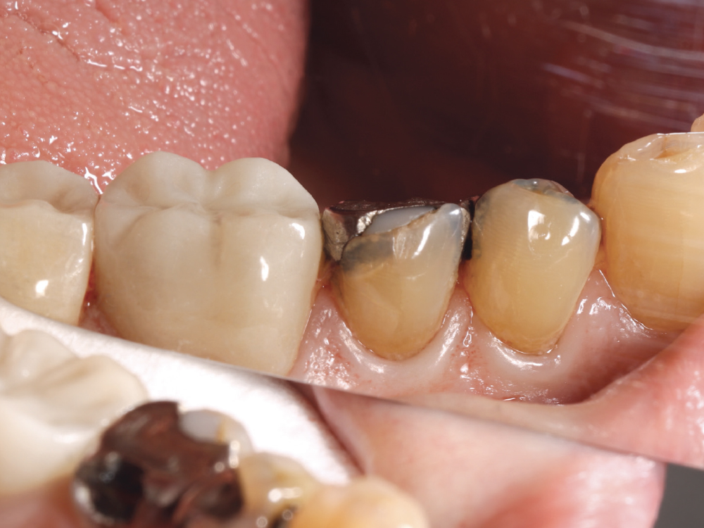 Dr. Browder chose Obsidian because of the combination of strength and lifelike translucency for a restoration that will stand the test of time and look beautiful.