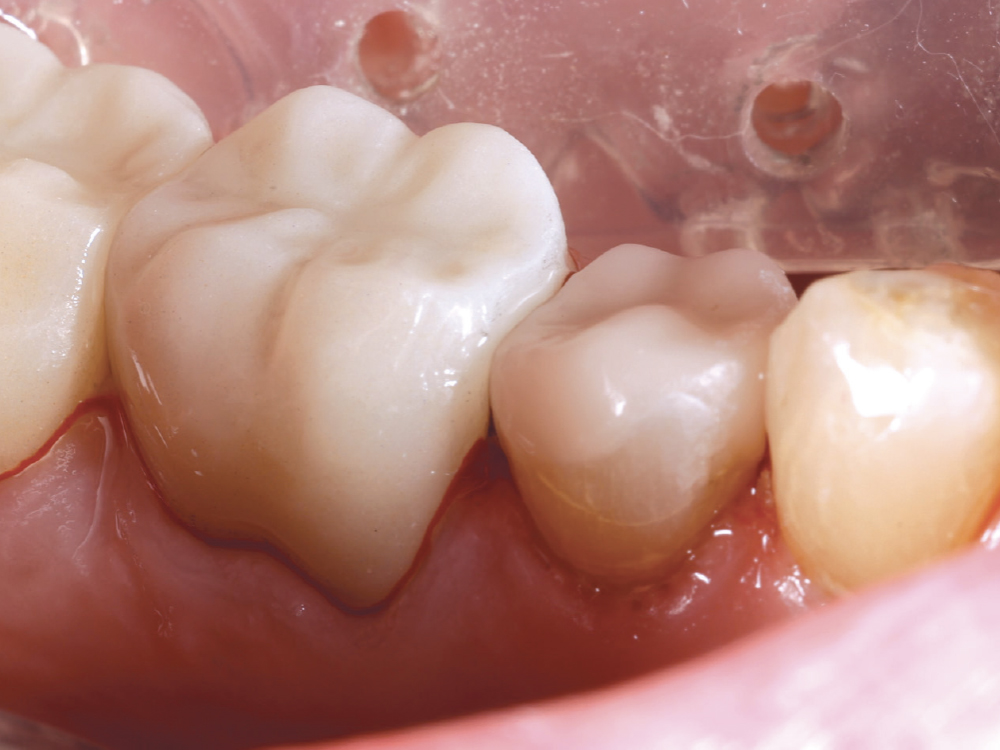 Dr. Browder chose Obsidian because of the combination of strength and lifelike translucency for a restoration that will stand the test of time and look beautiful.