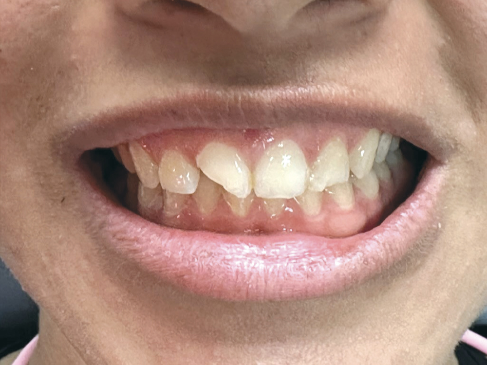 A 16-year-old patient entered the office after breaking tooth #8 during sports practice. Dr. Ekhtiar Kord chose to restore her front tooth with CAMouflage NOW due to the biomimetic nature of the material, its minimally invasive approach, and the speed with which she can provide a final restoration.
