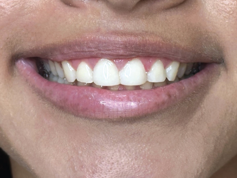 A 16-year-old patient entered the office after breaking tooth #8 during sports practice. Dr. Ekhtiar Kord chose to restore her front tooth with CAMouflage NOW due to the biomimetic nature of the material, its minimally invasive approach, and the speed with which she can provide a final restoration.