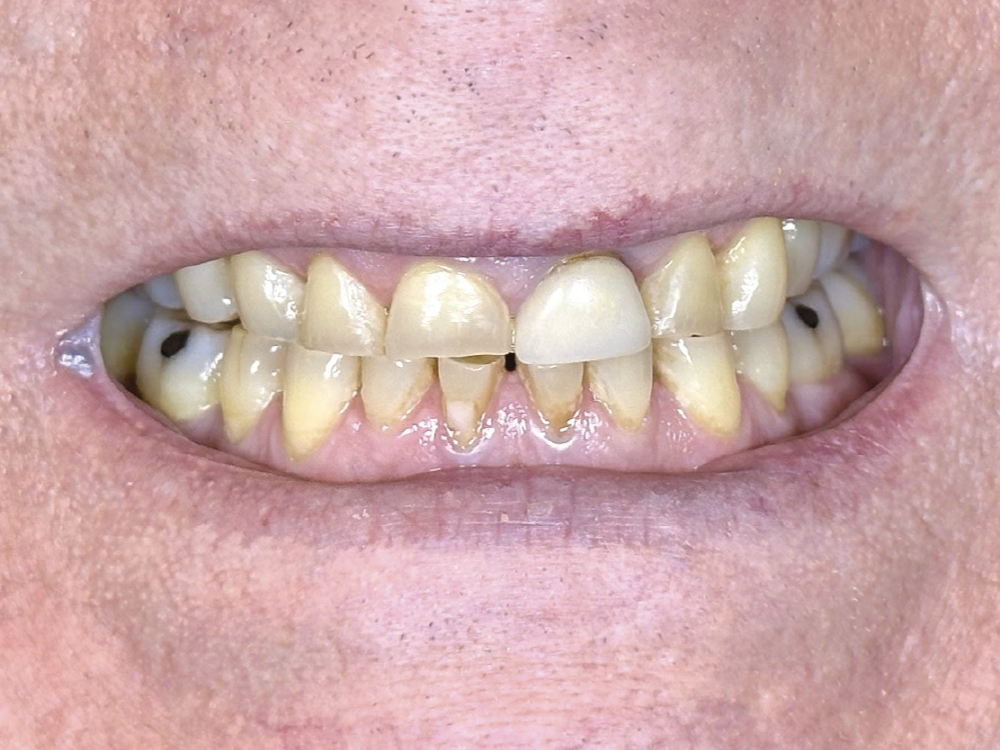 After years of disliking the appearance of her teeth, this patient asked Dr. Zant to restore her smile to its former glory. He achieved her goal by restoring it with BruxZir® Esthetic NOW crowns.