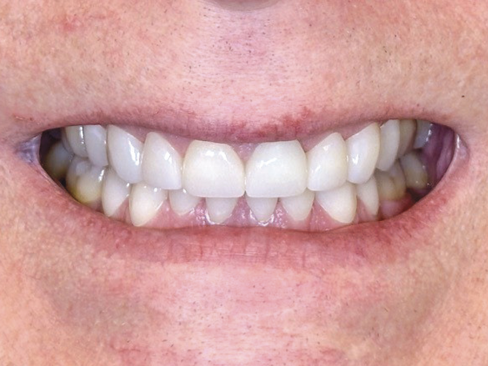 After years of disliking the appearance of her teeth, this patient asked Dr. Zant to restore her smile to its former glory. He achieved her goal by restoring it with BruxZir® Esthetic NOW crowns.