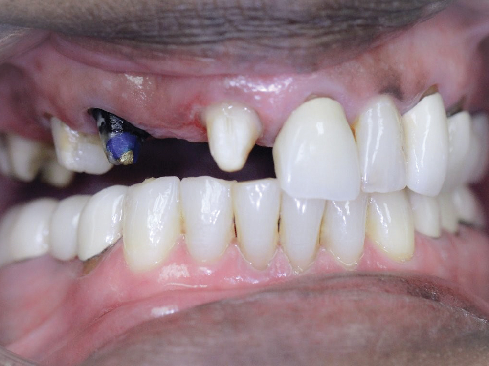 Cases involving the esthetic zone are particularly challenging. Dr. Le opted for a provisional restoration milled from BioTemps® NOW for both a fast process and great esthetics. Furthermore, the functionality of the provisional restoration helps preserve the patient’s soft tissue in position while awaiting the final restoration.