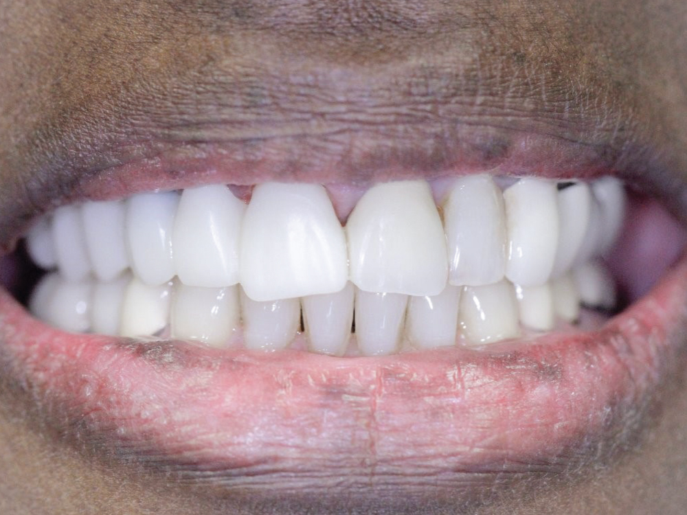 Cases involving the esthetic zone are particularly challenging. Dr. Le opted for a provisional restoration milled from BioTemps® NOW for both a fast process and great esthetics. Furthermore, the functionality of the provisional restoration helps preserve the patient’s soft tissue in position while awaiting the final restoration.