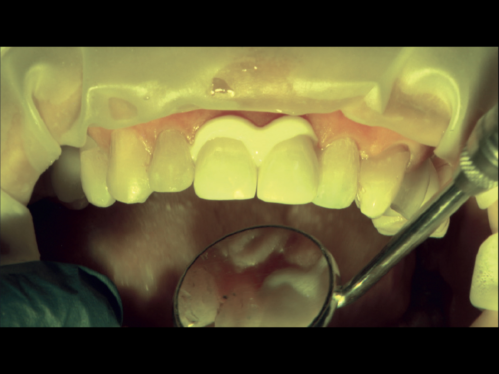 The BruxZir Dual Cure Resin cement in use on teeth