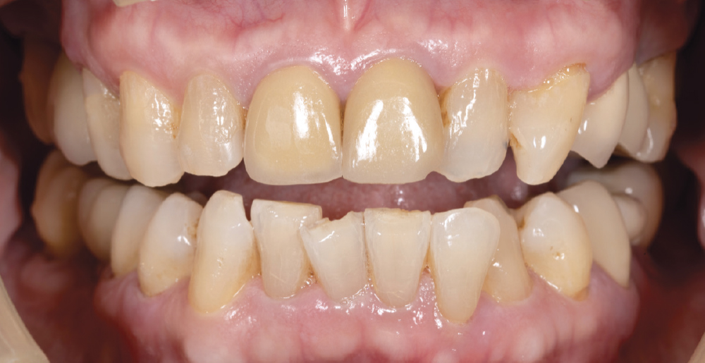 Patient with open margins and chip on tooth #9