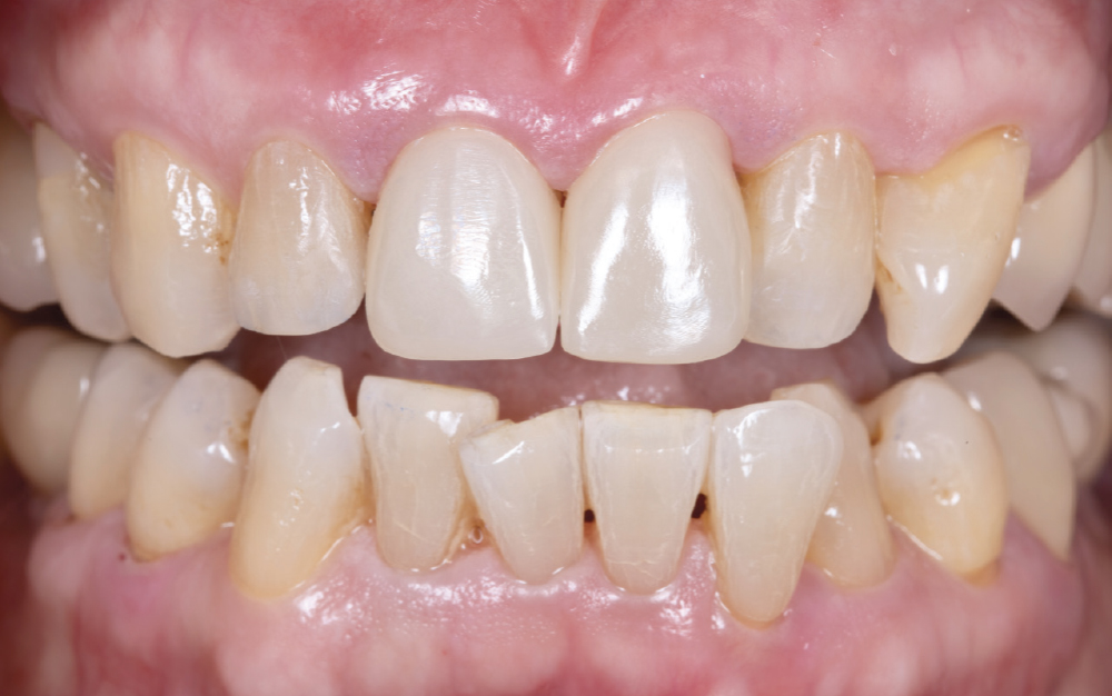 End result of simplified cementation