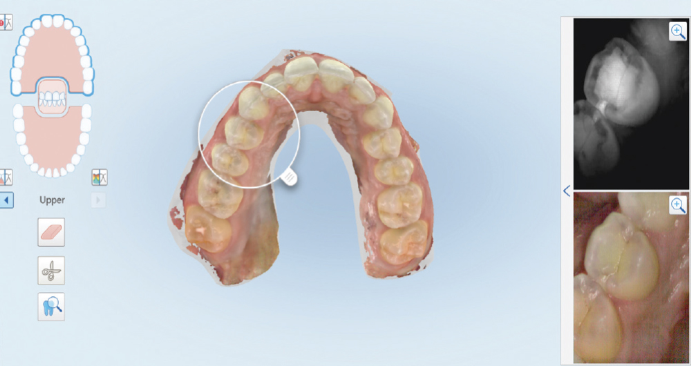 The iTero Element™ 5D utilizes near infrared technology for caries detection.