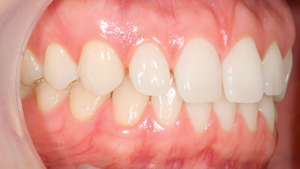 Clinical Spotlight NoPrep Veneers