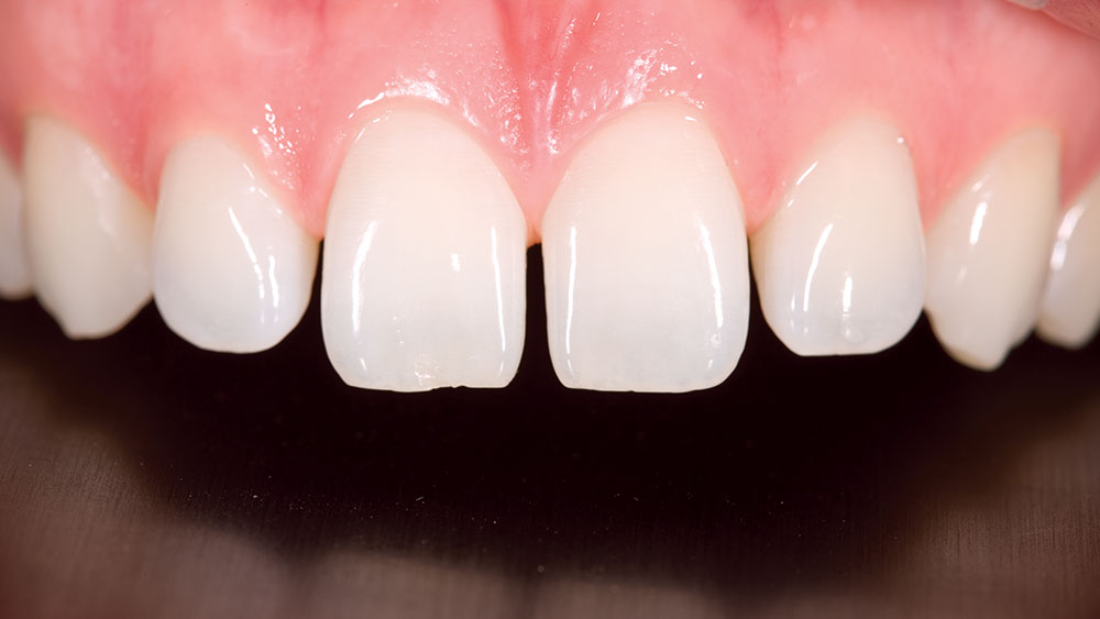 Clinical Spotlight NoPrep Veneers