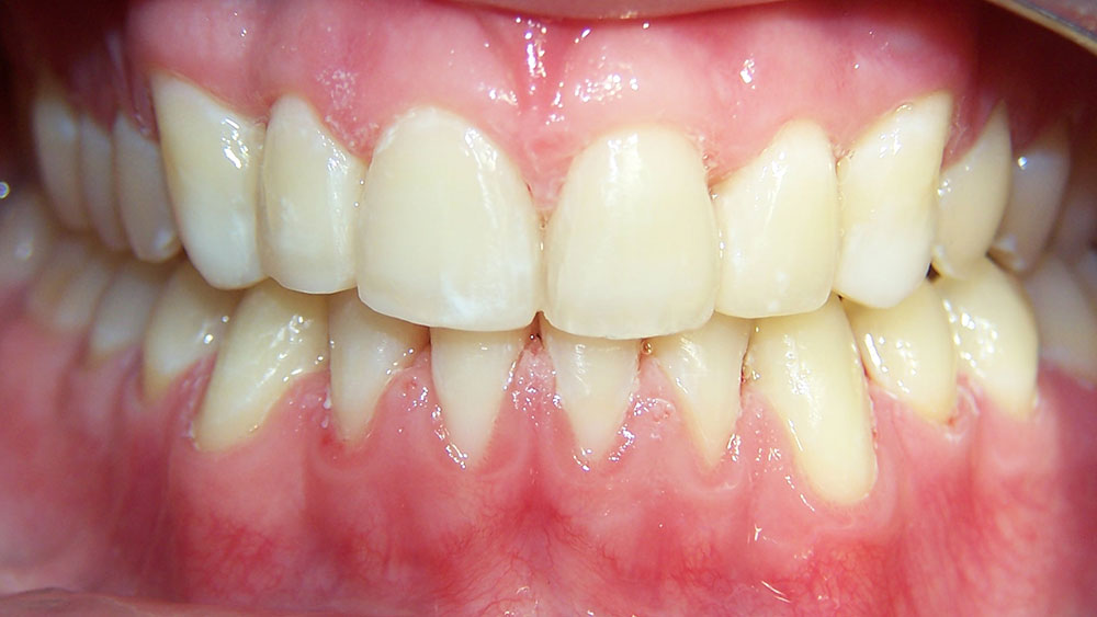 cm0203-6-month-orthodontics-04