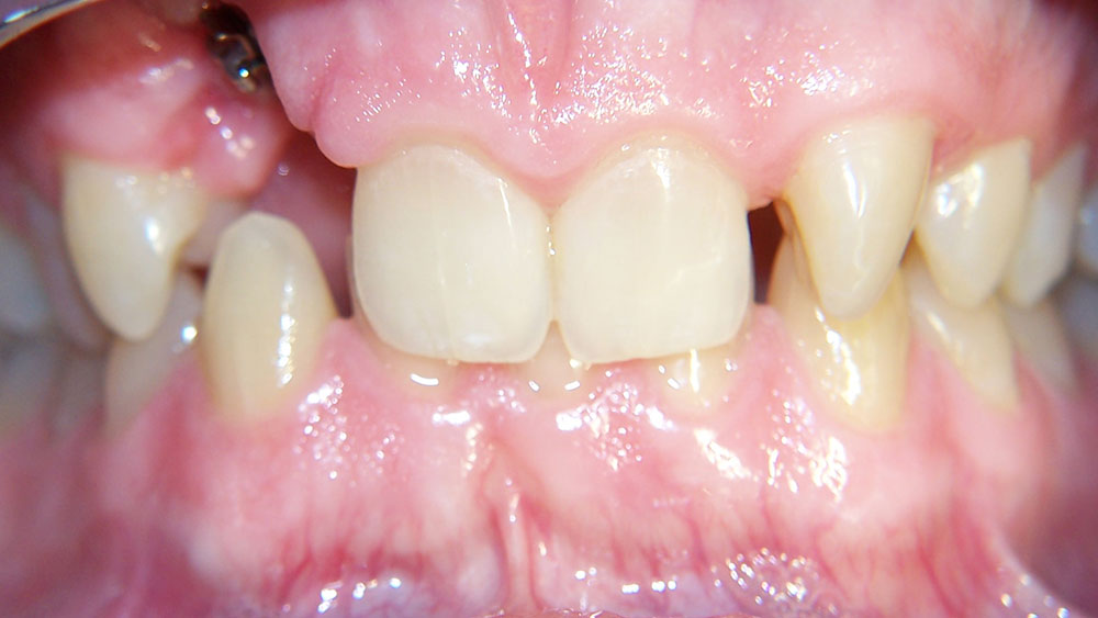 cm0203-6-month-orthodontics-07