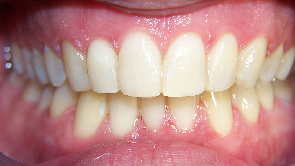 cm0203-6-month-orthodontics-15