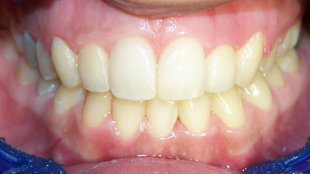 cm0203-6-month-orthodontics-11