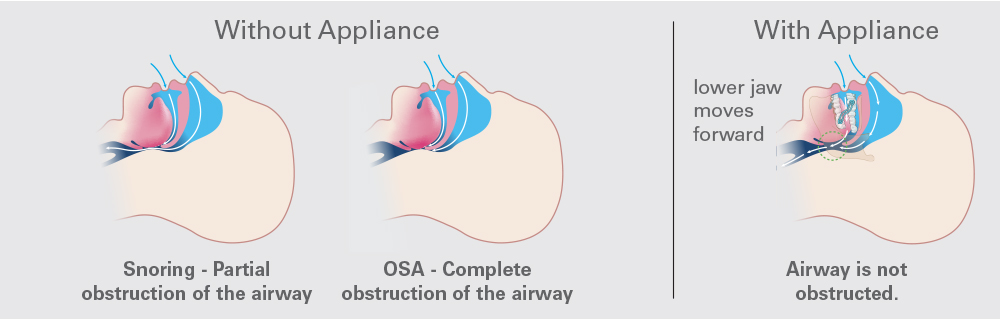 Snoring is due to a partially collapsed airway