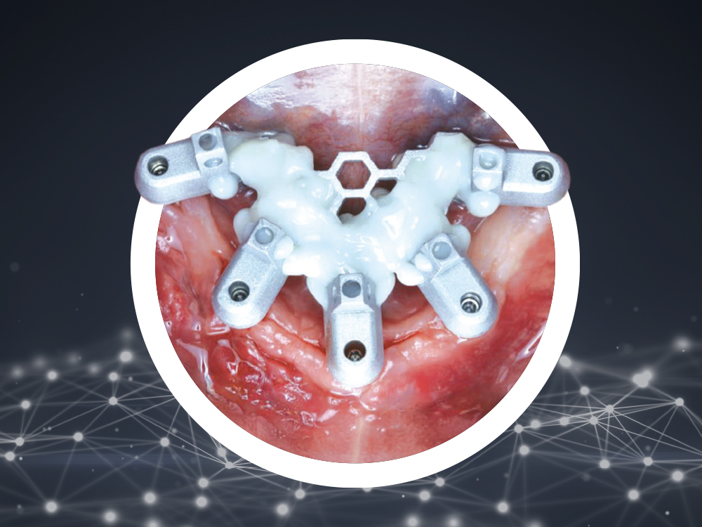 Full-Arch Protocol with ArchTracer™ and OptiSplint® Technologies Full-Arch Protocol with ArchTracer™ and OptiSplint® Technologies