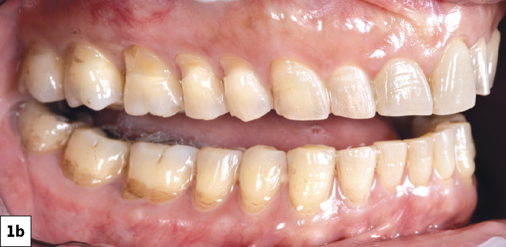 Close-up of stained human teeth