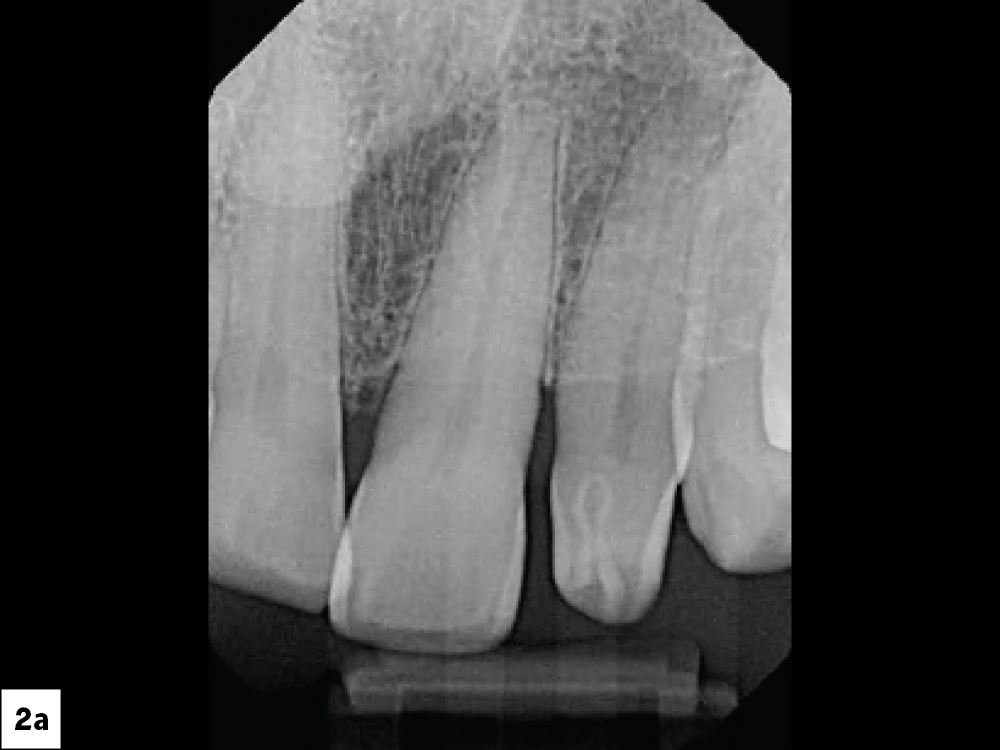 Dental X-ray showing teeth and roots