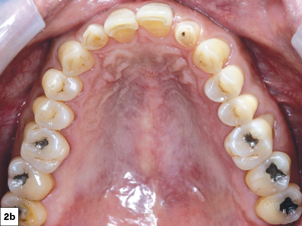 Close-up of upper dental arch