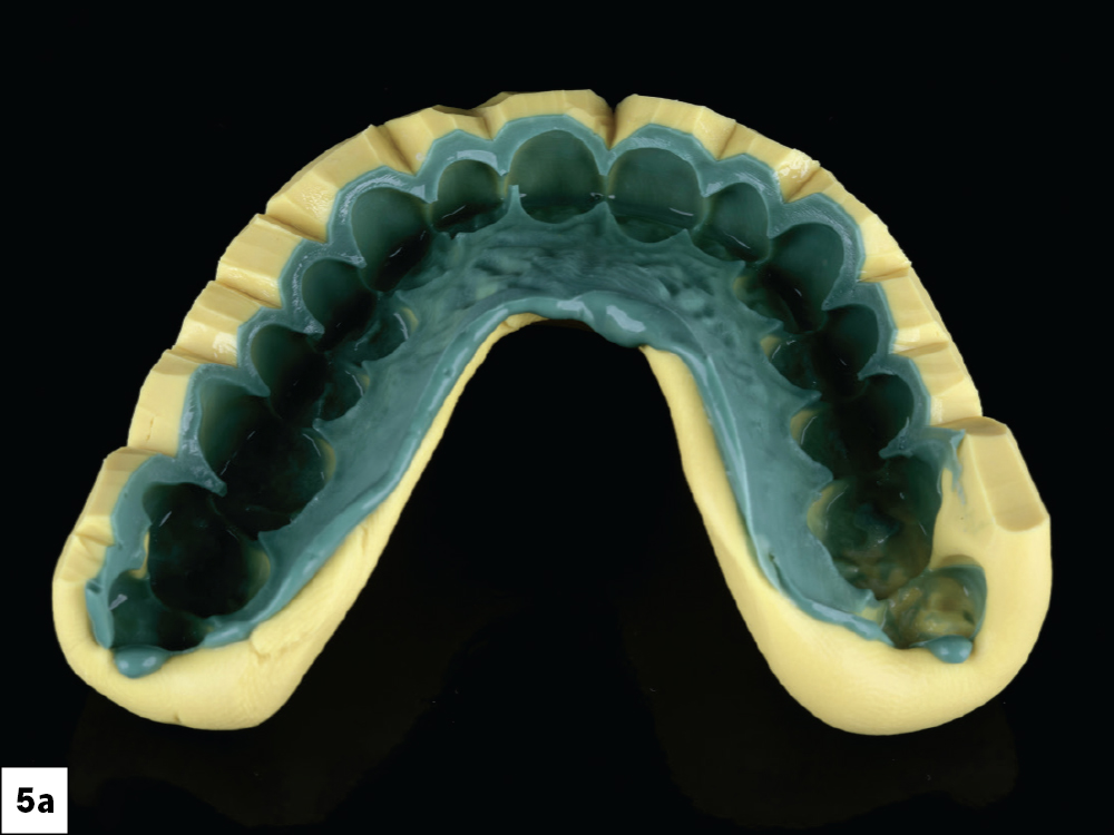 Dental impression mold with green material