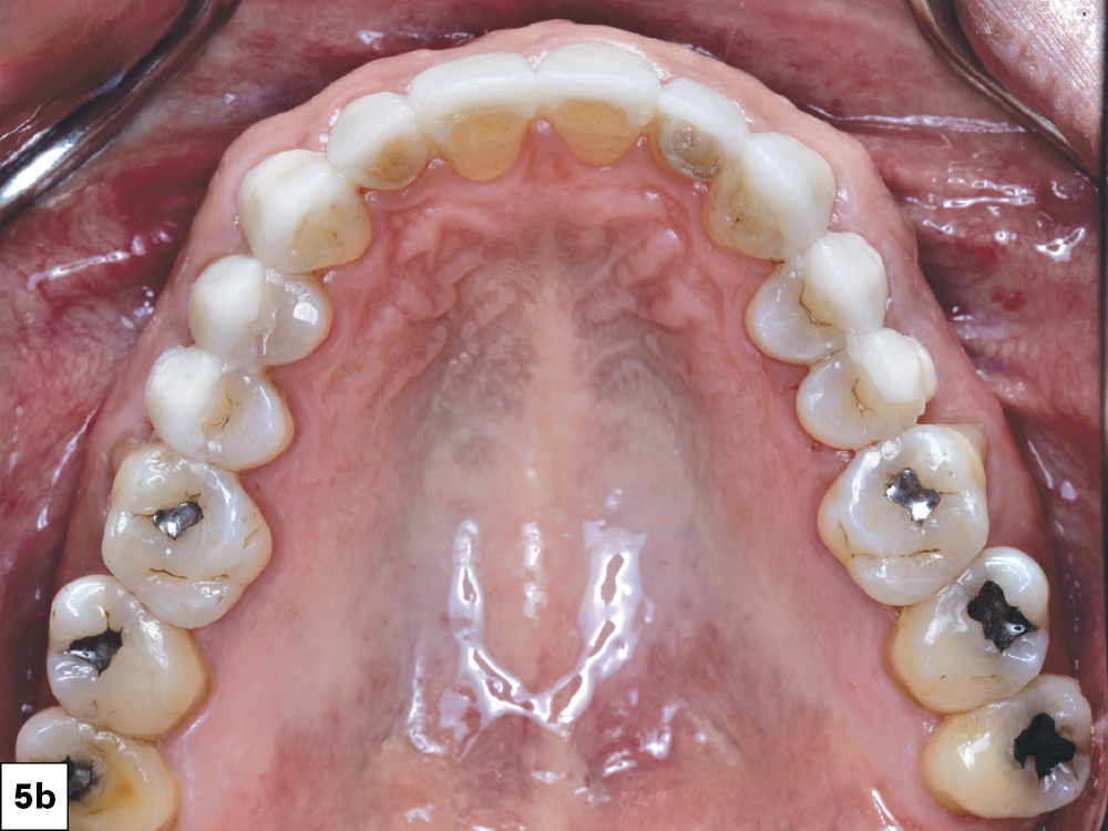 Close-up of dental cavities and fillings