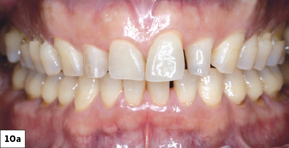 Close-up of human teeth with dental issue