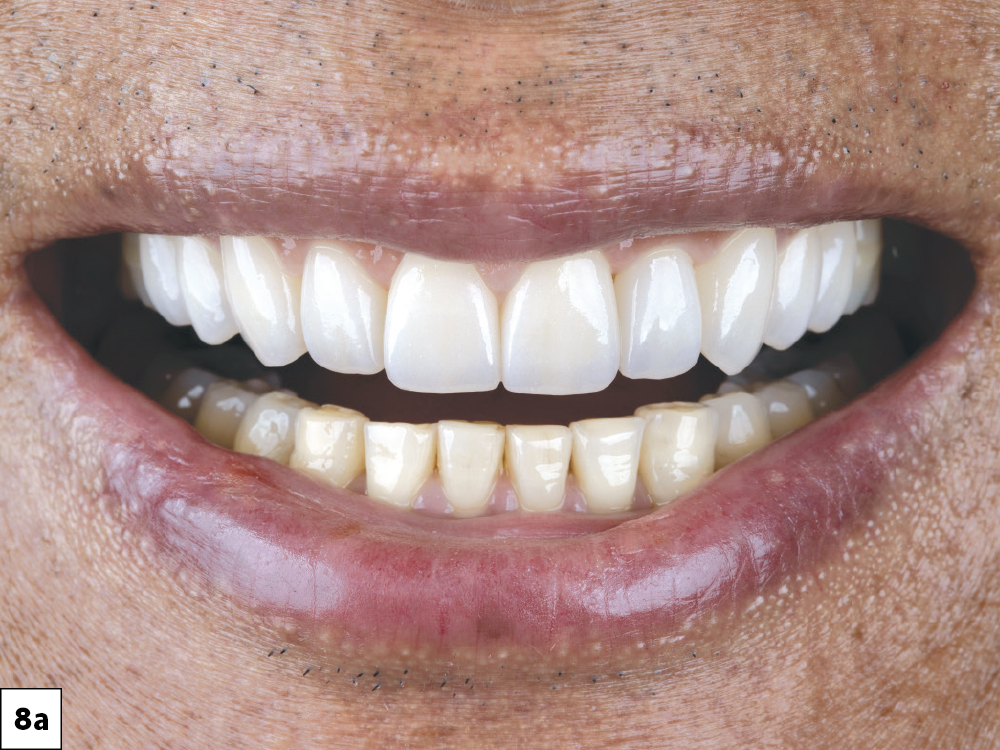 Close-up of teeth showing whitening results