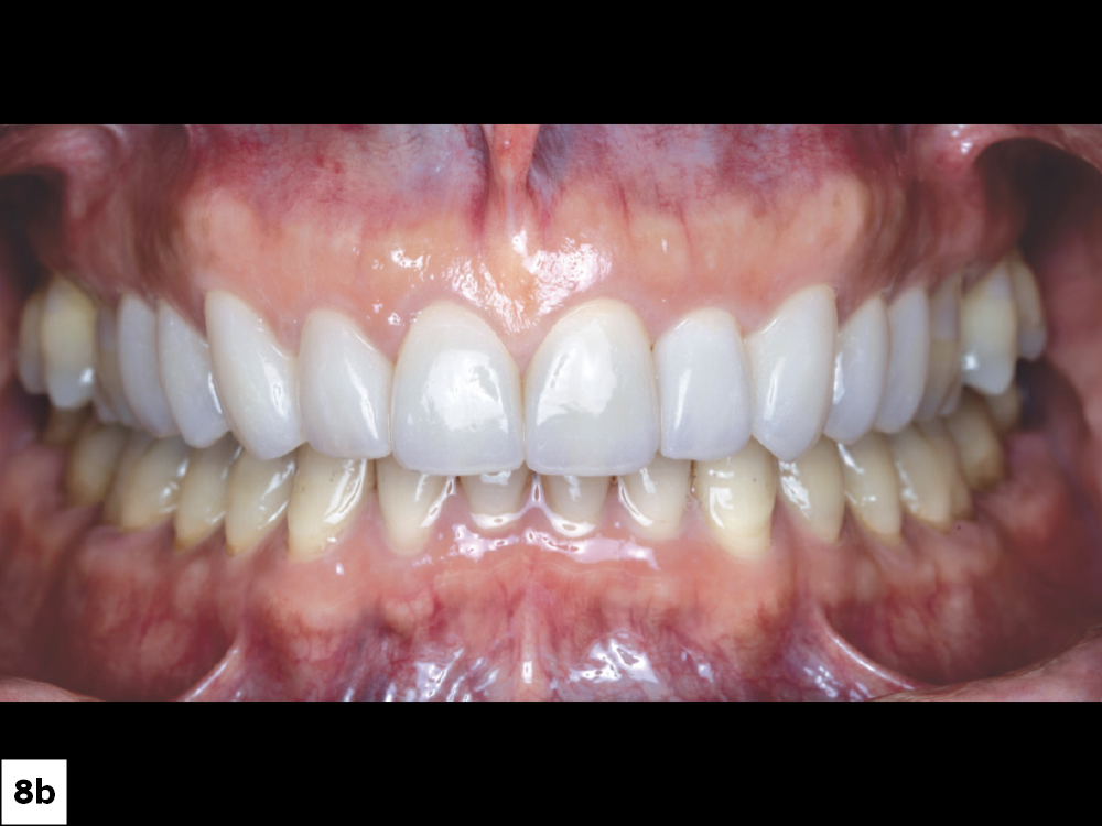 Close-up of dental veneers on teeth