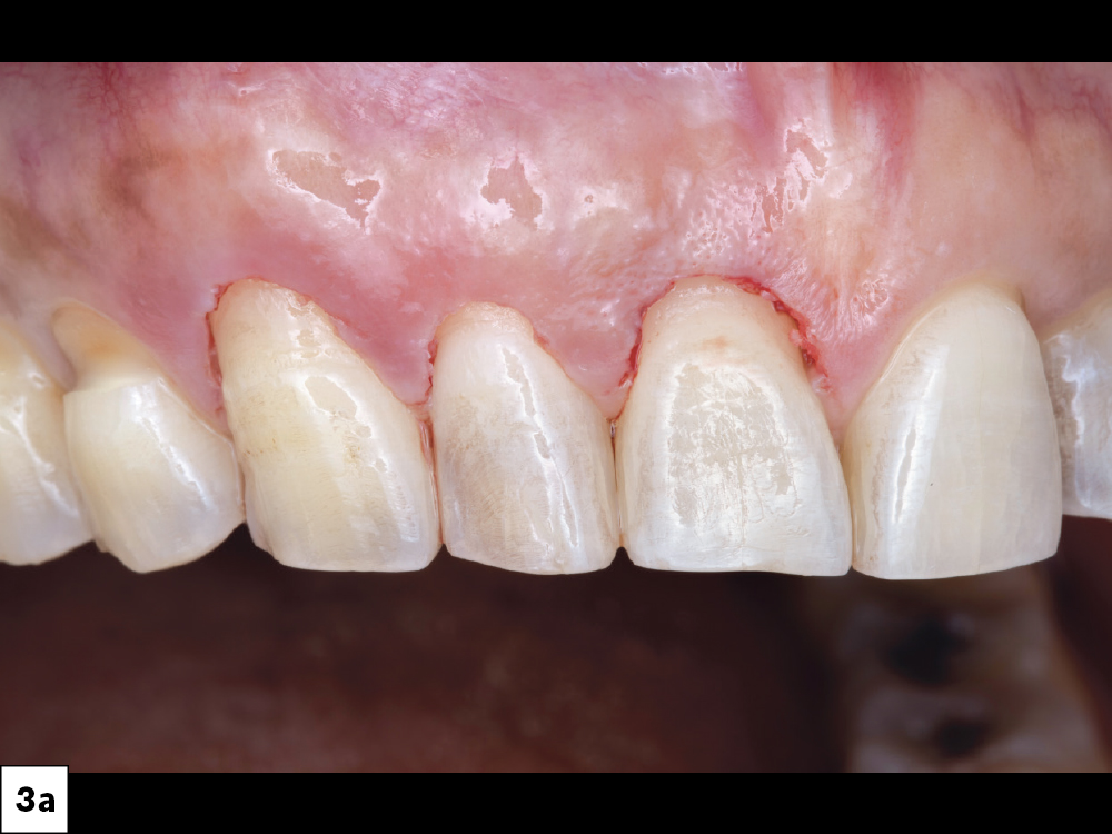Close-up of teeth with gum recession