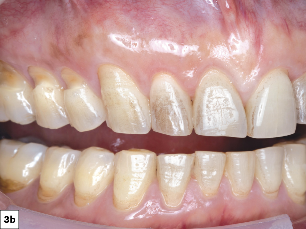 Close-up of stained human teeth