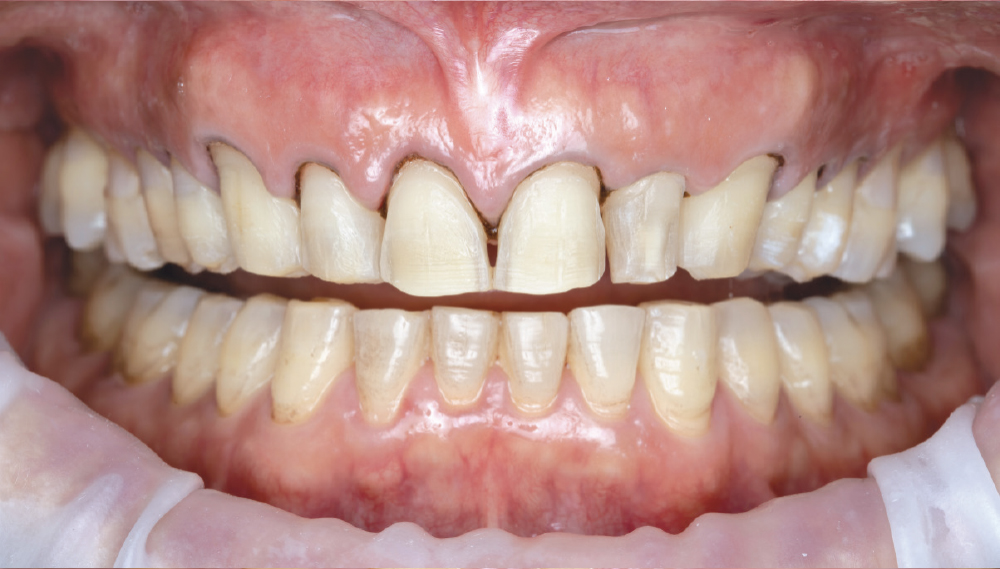 Close-up of human teeth and gums