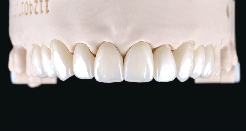 Dental prosthetic model with upper teeth