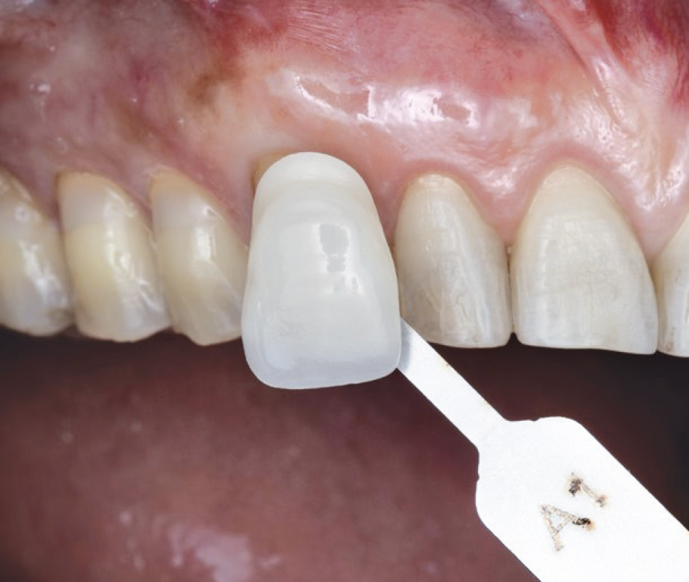 Dental shade matching with A1 guide